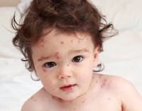 Baby suffering with chicken pox
